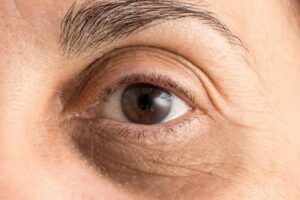 Dark Circles Under The Eyes: Causes & Treatments